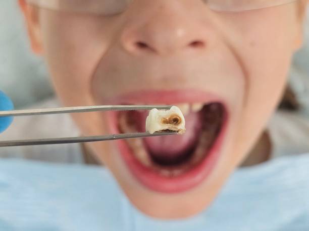 Best Pediatric Emergency Dentist in Plymouth, WI